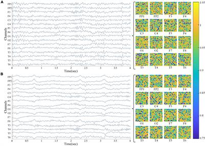 Identifying Amnestic Mild Cognitive Impairment With Convolutional Neural Network Adapted to the Spectral Entropy Heat Map of the Electroencephalogram